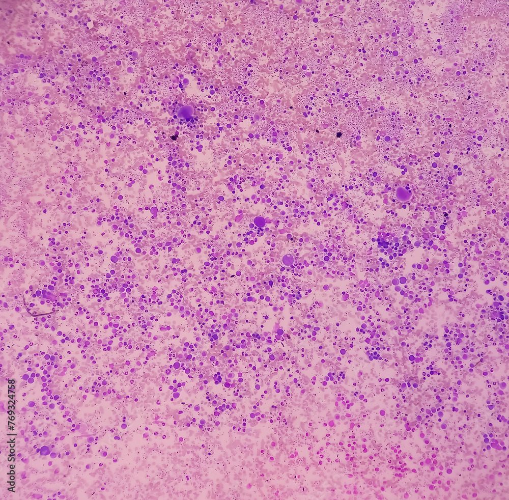 Canvas Prints Essential thrombocytosis blood smear showing abnormal high volume of platelet and White Blood Cells. Panmyelosis. Myeloprokiferative disorder.