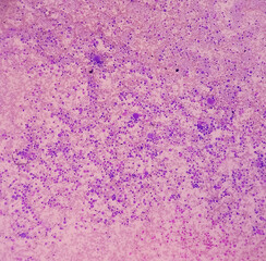 Essential thrombocytosis blood smear showing abnormal high volume of platelet and White Blood...