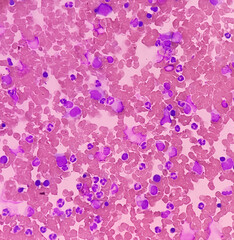 Bone marrow study. Panmyelosis. Myeloproliferative disorder. Thrombocytosis and neutrophilic...