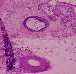 Mature cystic teratoma, Ovarian cyst biopsy, show cyst wall of skin and adnexal structure, fatty...