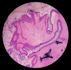 Mature cystic teratoma, Ovarian cyst biopsy, show cyst wall of skin and adnexal structure, fatty tissue, salivary acini and cartilage. Cystic teratoma of dermoid cyst.