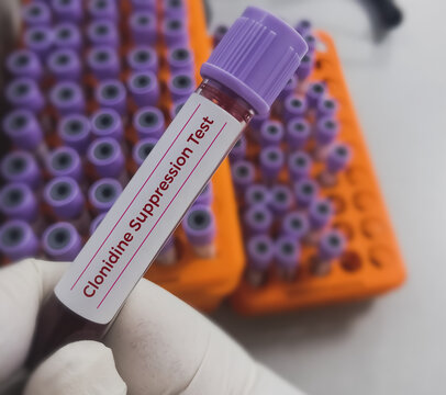Blood sample for Clonidine Suppression test to diagnosis of pheochromocytoma. Catecholamine-secreting tumor of chromaffin cells.