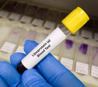 Blood sample for lipoprotein (a) or LpA blood test. Lipid profile. to diagnosis of high risk for heart disease and stroke. Bad cholesterol medical testing concept.