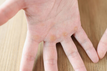 Calluses or corns on palmar surface of hand.