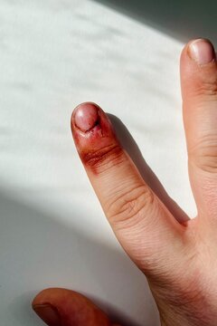 index finger of the right hand after a dog bite near the nail. wound, injury, blood. view from above. vet