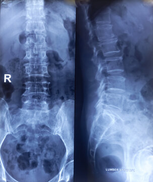 Lumbo sacral (LS) spine x-ray. Straightining of lumber lordotic curvature. Degenerative change, Marginal osteophytes. Partial compression collapse at L2 vertebra. Bilateral early sacroilitis.