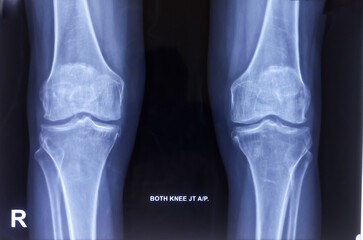 X-ray of both knee joint AP and lateral view. Osteophytes present. reduced joint spaces....