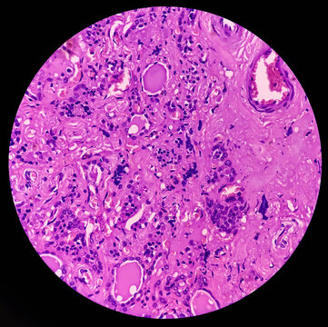 Thyroid cancer. Tracheal gland involved by tumor. Microscopic image of Metastatic papillary carcinoma of thyroid. Lymph node carcinoma.
