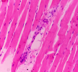 Microscopic image of above knee amputation. Section show fibro collagenous tissue, fatty tissue, skeletal muscles with inflammatory cells. Bony soft tissue resection margin. Bone cancer. - obrazy, fototapety, plakaty