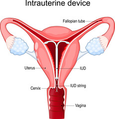 Intrauterine device or coil. uterus with IUCD or ICD inside