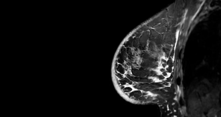Breast MRI revealing BI-RADS 4 in women indicates suspicious findings warranting further investigation for potential malignancy.