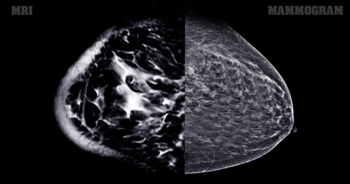Breast MRI revealing BI-RADS 4 in women indicates suspicious findings warranting further investigation for potential malignancy.