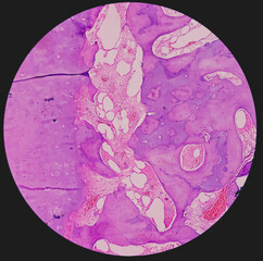 Distal femur (biopsy): Exostosis. Section show mature hyaline cartilage with overlying fibrous perichondrium.