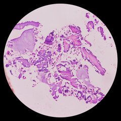 Distal femur (biopsy): Exostosis. Section show mature hyaline cartilage with overlying fibrous perichondrium.