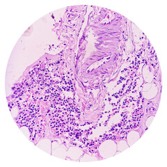 Inguinal lymph node (excised): Lymphoproliferative disorder (LPD). Section show lymph node.