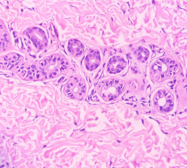 Hand skin tissue (biopsy) : Prurigo nodularis. Microscopically show skin and hyperkeratosis,...