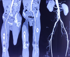 CT angiogram (CTA) shown the abdominal aorta, kidney and common iliac artery. Calcified plaques in...