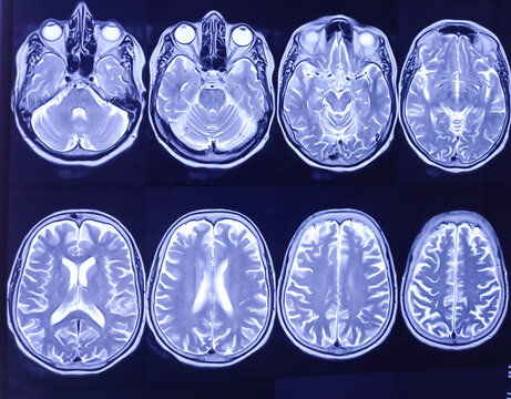 MRI (Magnetic Resonance Image) of brain. Cerebral cortical atrophy.