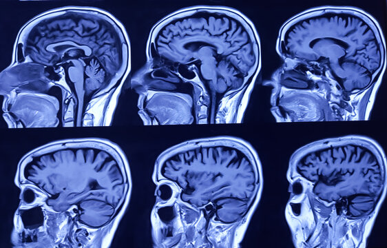 MRI (Magnetic Resonance Image) of brain. Cerebral cortical atrophy.