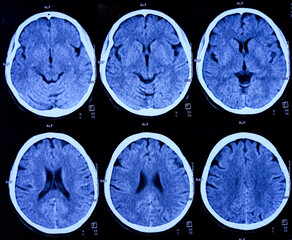 CT (Computed Tomography) scan of brain. Multiple slice scan of brain and normal finding.