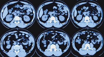 CT scan of KUB (non-contrast): Right lower ureteric calculus (at vesicoureteric junction) causing...
