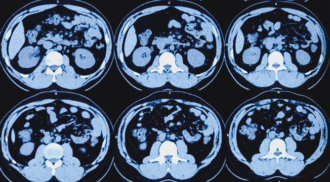 CT scan of KUB (non-contrast): Right lower ureteric calculus (at vesicoureteric junction) causing moderate hydroureteronephrosis of right kidney. Obstructive uropathy.
