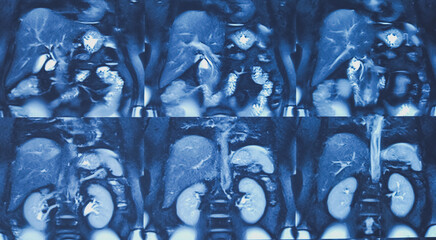 MRCP film of MRI of abdomen. Hepatic parenchymal tiny calcification, hepaticolithiasis. Liver, bile...
