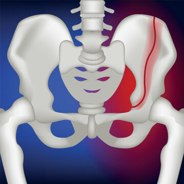 Vertical fracture of the pelvic bone. 3d rendering on a blue background. Medina vector illustration