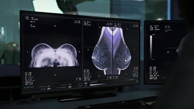 Doctor Observes Software Analyzing Woman Breast For Clinical Diagnosis. Clinic Doctor Uses X-ray Scanner To Diagnose Disease. Doctor Examining Patient. Clinical Diagnosis With Medical Program