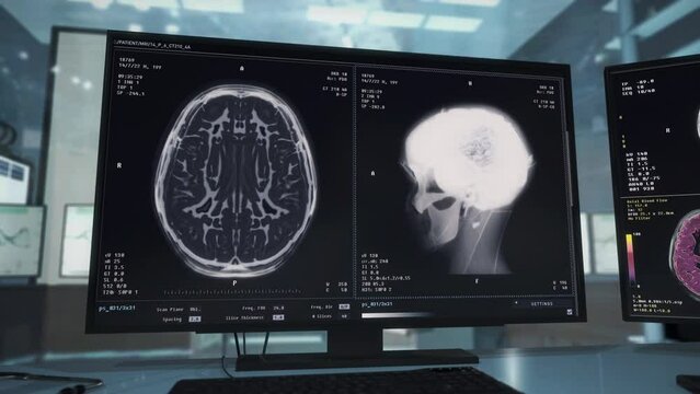 Medical analysis of the human brain at the hospital. Modern medical scanning mri equipment deals with the analysis of patients brain. Medical analysis diagnosing cancer in the brain.