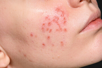 Skin healing period after erbium laser facial resurfacing. Young woman suffering from problem skin....