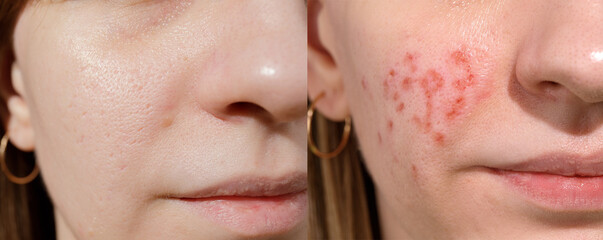 Young woman suffering from problem skin. Treatment of ice pick scars. Erbium laser facial...