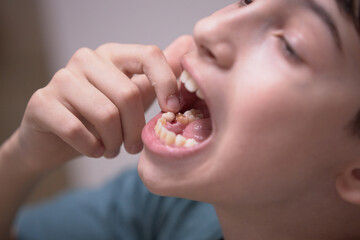 A boy's tooth falls out of his mouth in close-up