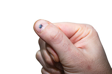 hand with a hematoma on the nail from a blow with a blunt object close-up on an isolated white...