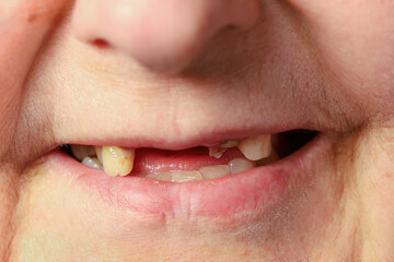Close-up, toothless mouth of smiling elderly woman