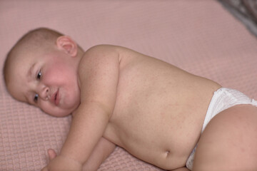 Roseola of the course of the disease in the baby, rash on the skin, the baby is capricious and sluggish