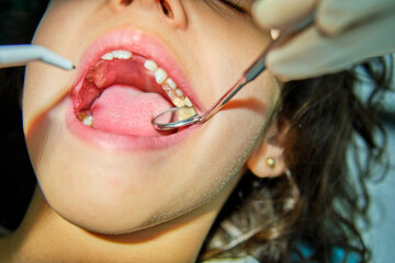 A detailed close up view of a dental examination, showcasing the intricate work of oral health professionals