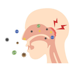 上咽頭に細菌がつき炎症を起こす横から見た頭部のイラスト