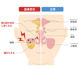 慢性副鼻腔炎が起こる仕組みと原因の比較図