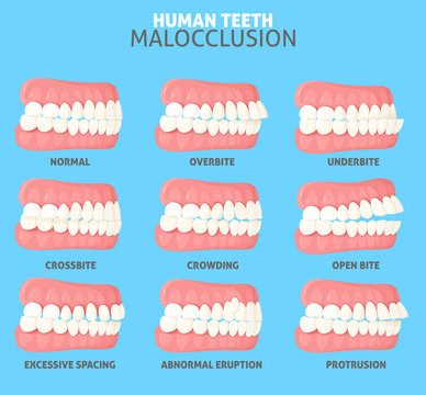 Malocclusion types side view dentist medical poster