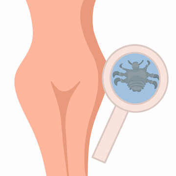 Vector isolated illustration of female pubic lice. Contact with a person with pubic lice.
