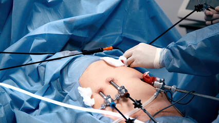 Surgeons use an endoscope during laparoscopy surgery. Concept of surgery, health and modern medical...