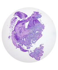Sigmoid colon (colonoscopic biopsy): Chronic nonspecific colitis. Show colonic mucosa, chronic...