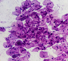 Light micrograph of a vaginal smear showing adenocarcinoma cells (center). Vaginal cancer....