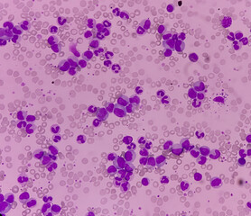 Blood cancer. Chronic myelogenous leukemia, also known as Chronic myeloid leukemia(CML) with Thrombocytosis.