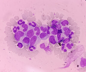 Blood cancer. Chronic myelogenous leukemia, also known as Chronic myeloid leukemia(CML) with...