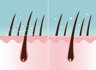 Comparison of dandruff in hair and healthy hair on scalp layer vector illustration. Hair with white dry flaky, scaly scalp and nourished. Hair care and problem concept. - obrazy, fototapety, plakaty