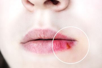 Girl's lips affected by herpes. - obrazy, fototapety, plakaty