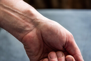 Female hand with a hygroma or wrist ganglion cyst.