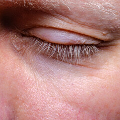 Papilloma on the human eye close-up